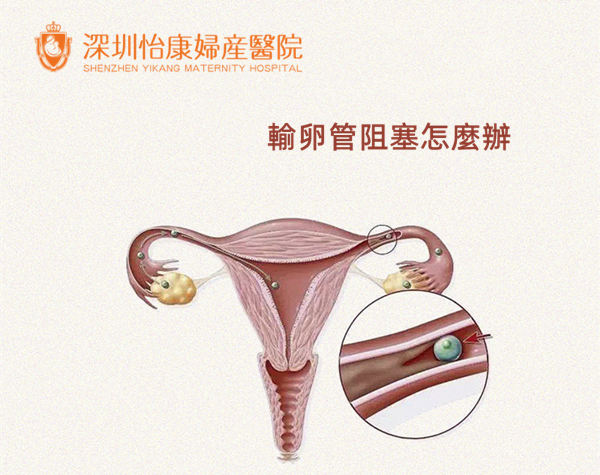 輸卵管阻塞點樣驗怎麼治療-輸卵管阻塞手術費用-輸卵管疏通